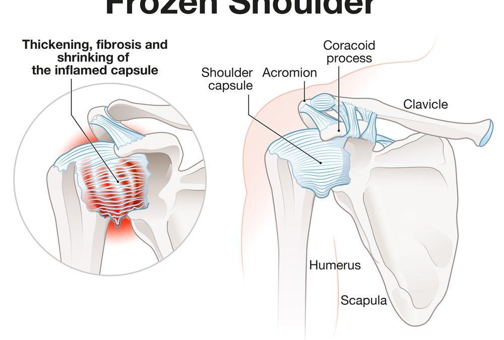 Wat is een frozen shoulder?