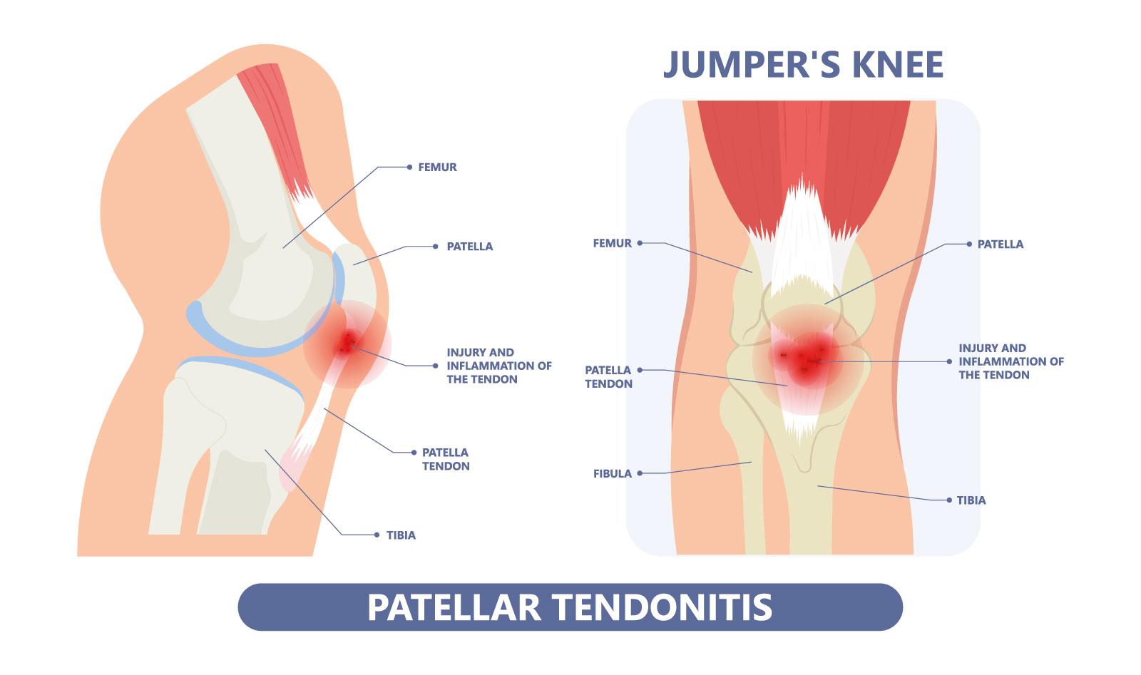 wat-is-een-springersknie-fysiotherapie-fitness