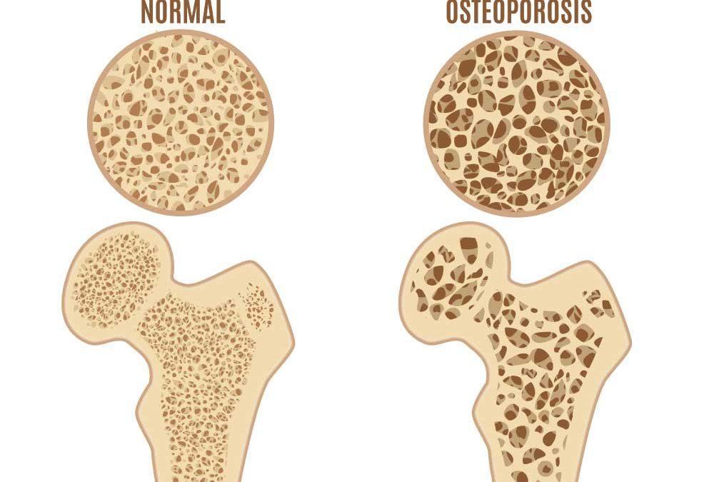 Wat is osteoporose?